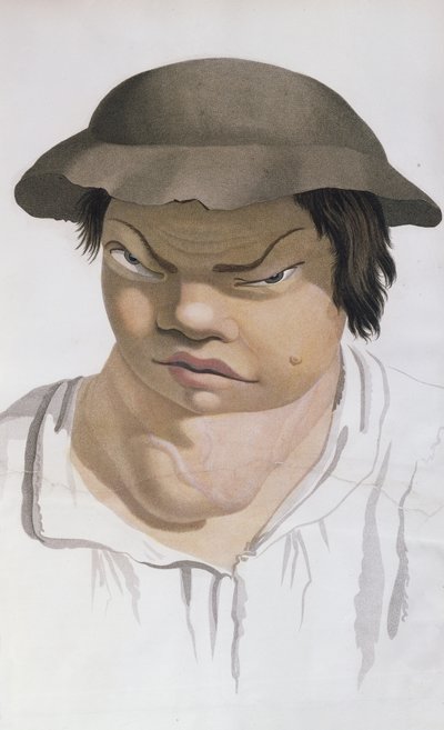 Endemische Skrofulose, Illustration aus einem Buch von Baron Jean Louis Alibert (1768-1837) von Salvadore Tresca